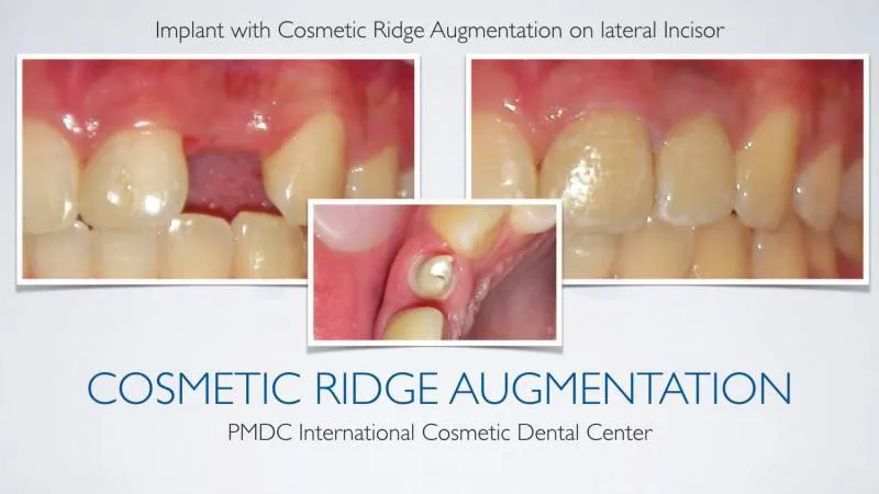 Before - Dental Implants