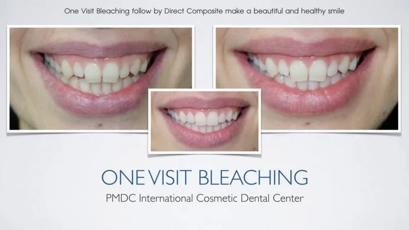 Before - Teeth Whitening