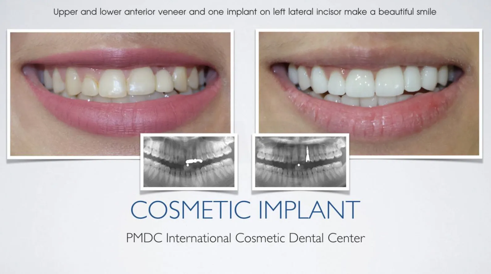 Before - Dental Implants