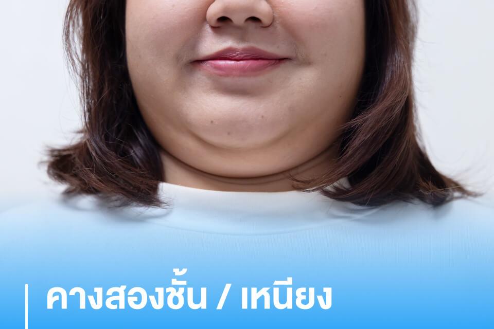 ไขความลับ 5 จุด "ดูดไขมัน" ที่หลายคนอาจยังไม่เคยรู้ กู้หุ่นเป๊ะปังแบบคาดไม่ถึง