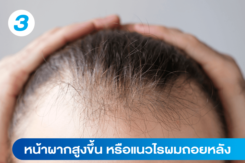 ผมร่วง-ผมบาง-แบบไหนที่อาจต้องปลูกผม-5-สัญญาณเตือนที่คุณควรรู้-4