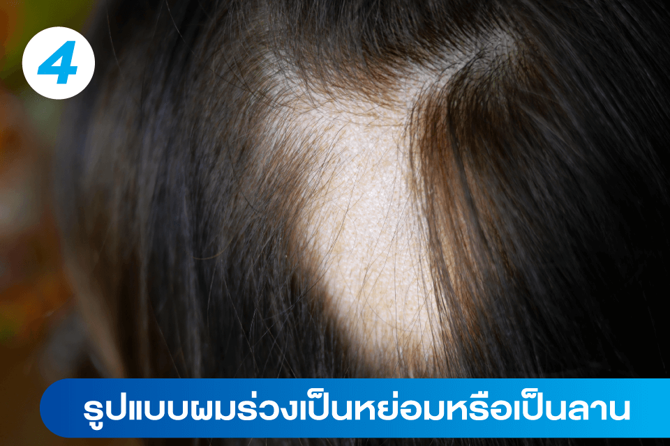 ผมร่วง-ผมบาง-แบบไหนที่อาจต้องปลูกผม-5-สัญญาณเตือนที่คุณควรรู้-5